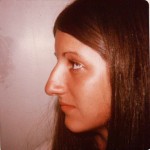 Rhinoplasty before